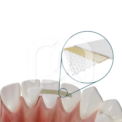 DENTAPREG PFM SINGLE (6CM)