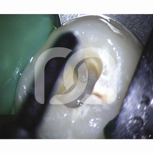 TIPS START-X - TIPS N°1 COMPATIBLE SATELEC