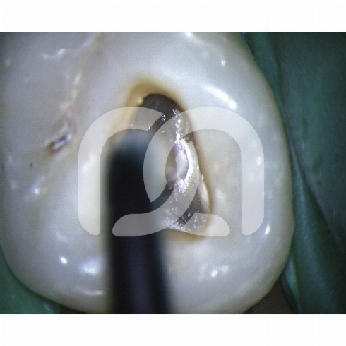 TIPS START-X - TIPS N°1 COMPATIBLE SATELEC