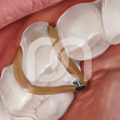 PINCE THE TEAR DROP HU-FRIEDY