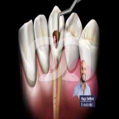 Hoe de juiste endodontistische vijl kiezen? Hoe de juiste endodontistische vijl kiezen?