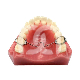 Arc Transpalatin Mésial pour Molaires (1) : LARGEUR:53 MM, POSITIONNEMENT:MESIAL
