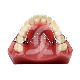 Dispositif d'Expansion Quad-Helix Maxillaire (1) : TAILLE:T-1